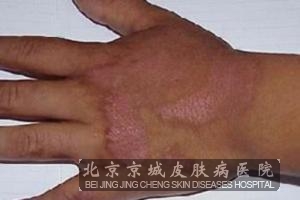 日光性皮炎的形成原因