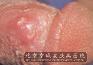 怎样预防生殖器疱疹的复发