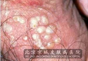 生殖器疱疹的复发原因是什么