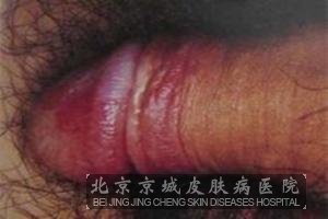 ��ֹ��ֳ�������Ҫ��ô����