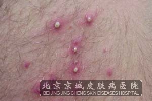 毛囊炎怎么办
