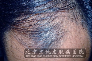 染发也能够引起脱发的现象