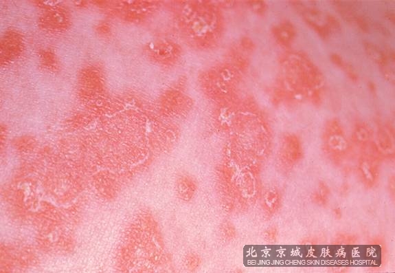 非淋菌性尿道炎图片