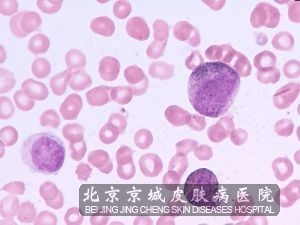 非淋菌性尿道炎图片