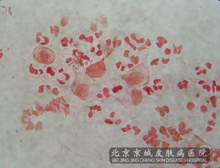 非淋菌性尿道炎图片