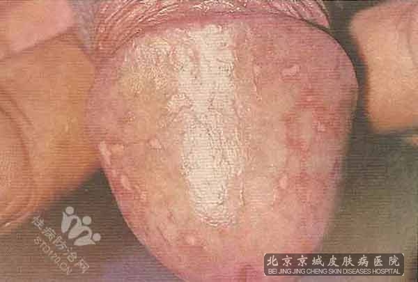 生殖器念珠菌病