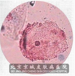 加特纳菌性阴道炎