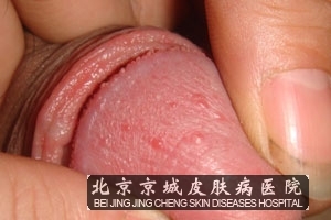 男人龟头红肿是什么原因导致的