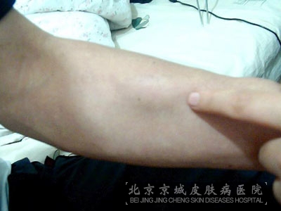 脂肪瘤综述