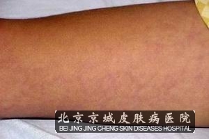 毛细血管扩张综述