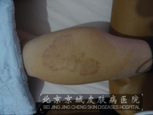 朝阳哪家治疗神经性皮炎好-兴义之窗健康频道