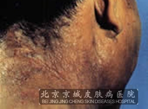 神经性皮炎北京朝阳区哪家医院好-兴义之窗健