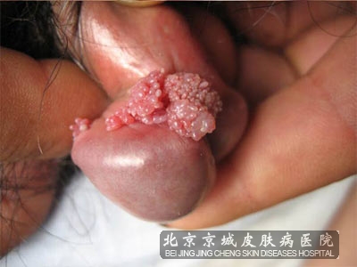 早期的尖锐湿疣有哪些症状