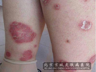 牛皮癣怎么的去治疗