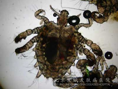 阴虱的发生主要有哪些原因