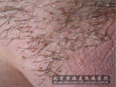 阴虱病的症状主要有哪些