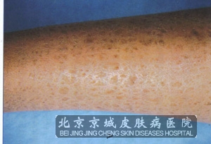 鱼鳞病怎么治疗