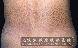 鱼鳞病该如何治疗