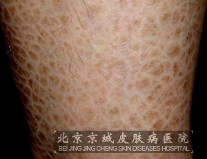 鱼鳞病怎么