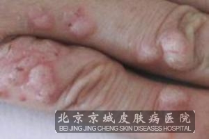 ��ƽ����û������֢״