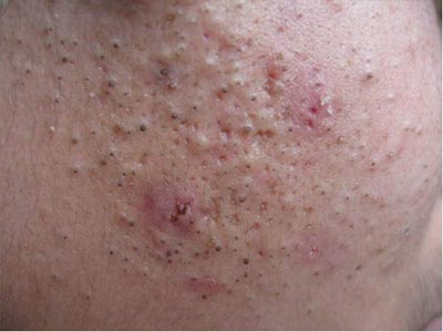 北京市治青春痘到哪个医院好-兴义之窗健康频