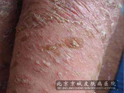 生活中牛皮癣是怎样出现的