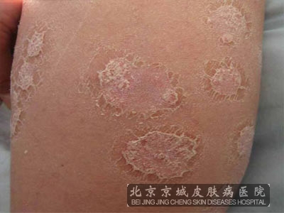 牛皮癣患者的护理有哪些