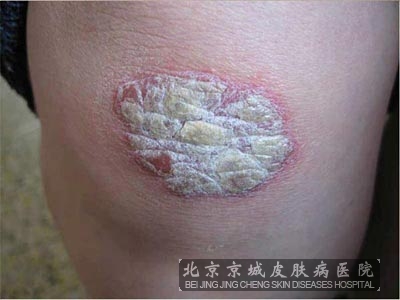 牛皮癣有哪些常见的症状