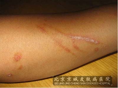 儿童要怎么预防牛皮癣