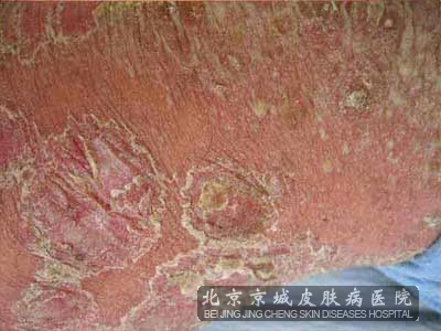 牛皮癣怎样治疗