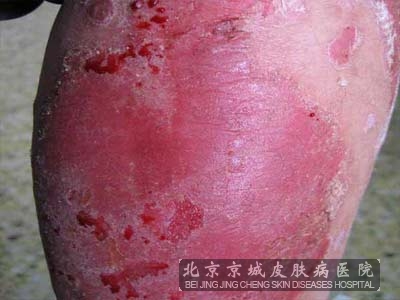 牛皮癣对患者造成的危害有哪些