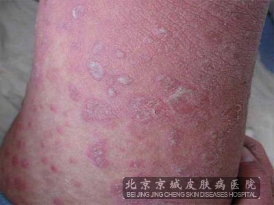 治疗牛皮癣注意哪些原则