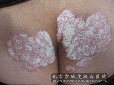 牛皮癣主要预防措施有哪些