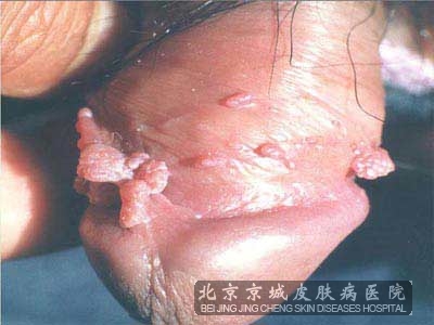 尖锐湿疣出现的因素有哪些