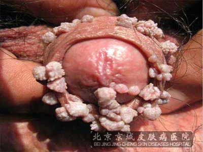 尖锐湿疣的危害是什么