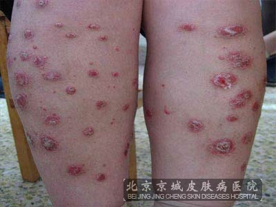 牛皮癣出现的原因有哪些