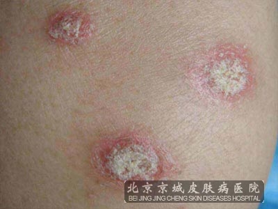 牛皮癣较常见的症状有哪些