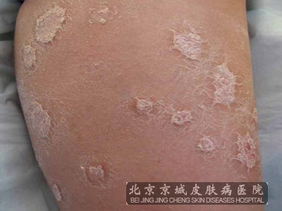 预防牛皮癣有什么好方法