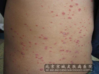 牛皮癣如何做好日常护理