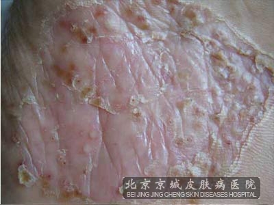 得了牛皮癣饮食要注意哪些