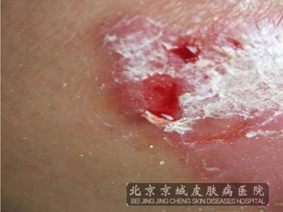 牛皮癣患者的日常护理有哪些