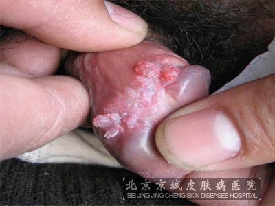 什么会引起尖锐湿疣