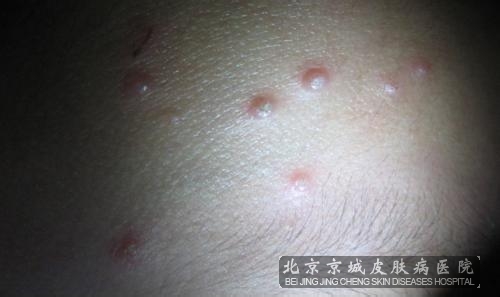 传染性软疣怎么预防呢