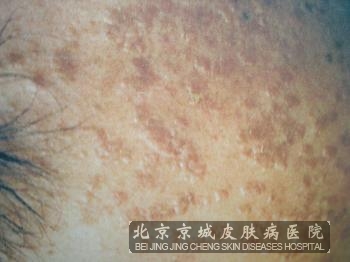 扁平疣该怎样护理