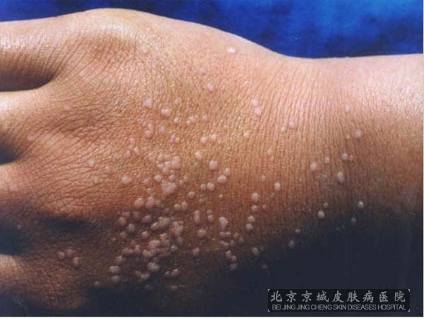 扁平疣治疗的秘方