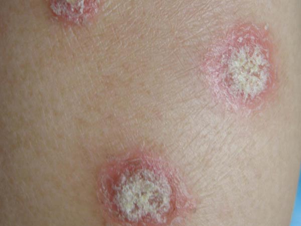 女性牛皮癣初期症状图片展示