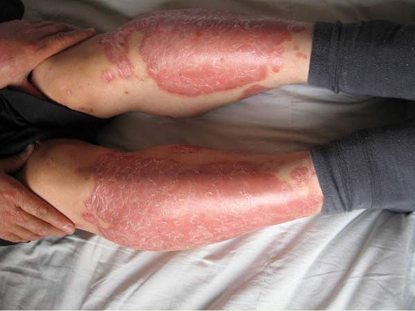 北京治疗副银屑病好的专科医院是哪