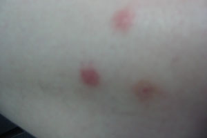 ݡ�����֢״�ϳ���������Щ