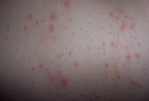 什么方法预防荨麻疹 