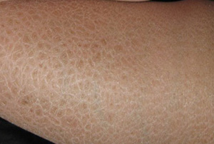 鱼鳞病患者可以多吃哪些食物